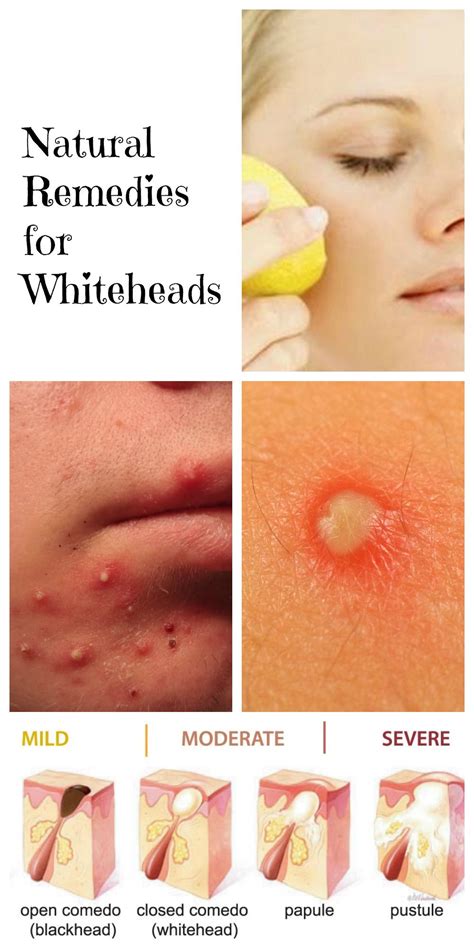 Whiteheads are small, hard, white or yellowish bumps – can be ...