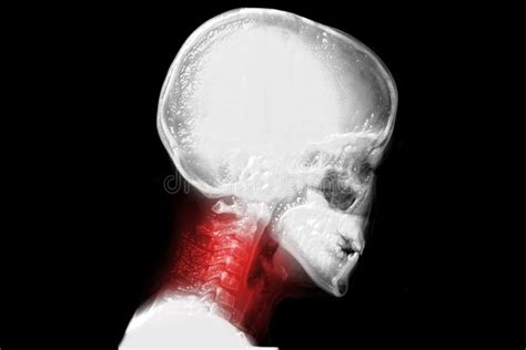 Cervical Vertebrae, Neck Pain Stock Photo - Image of tension, sore: 69574088