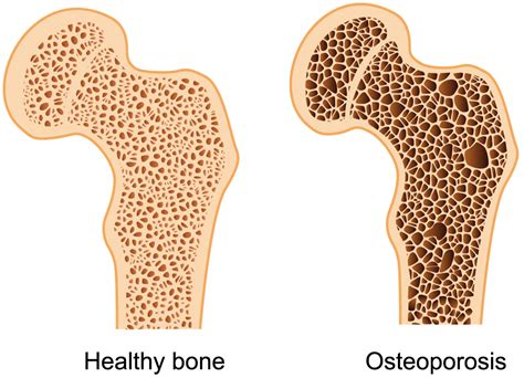 Exercise for bone density - What types of exercises are good for you? - Fitness Enhancement ...