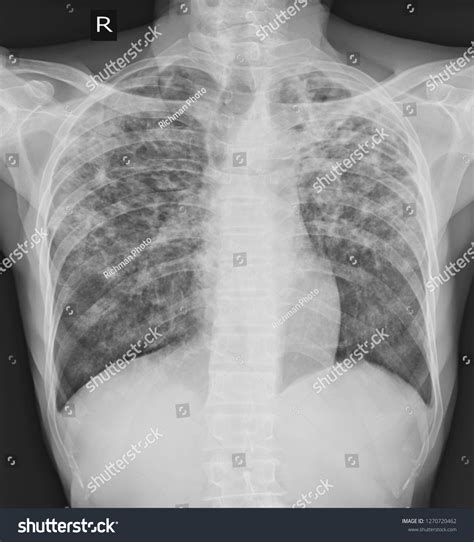 Pulmonary Tuberculosis Tb Chest Xray Old Stock Photo (Edit Now) 1270720462