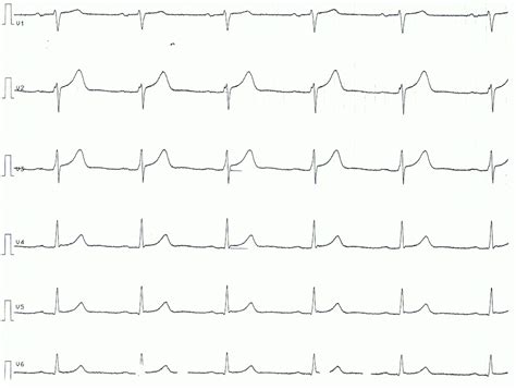 Pericarditis, myocarditis & perimyocarditis: ECG, criteria & treatment – Cardiovascular Education