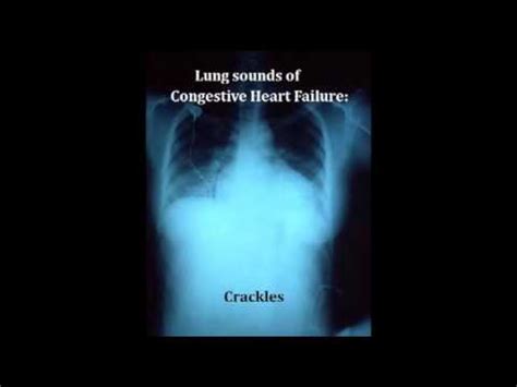 lung sounds - crackles - YouTube