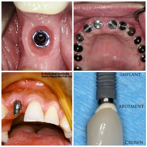 Dental implants, cover screw, abutment, crown- full post can be found on Assistantville on fb ...