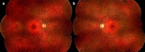 Autoimmune Retinopathy: Symptoms and Management | OBN