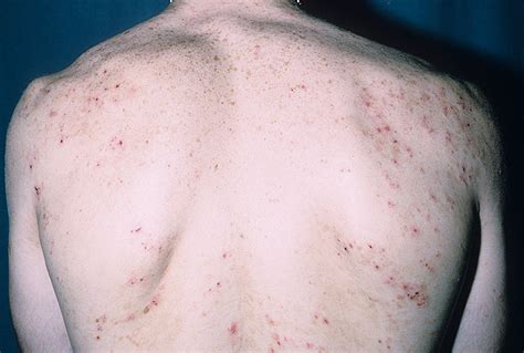 dermatitis herpetiformis pictures - pictures, photos