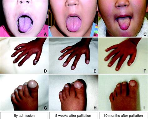 Rapid Regression of Classic Clinical Signs of Cyanosis Accompanied by ...