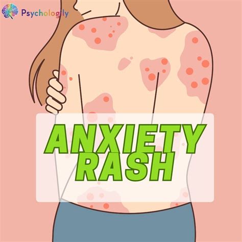 Anxiety Rash: Understanding the Link Between Stress and Skin Irritation ...