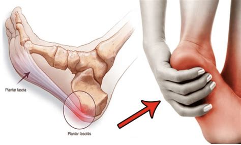 Plantar Fasciitis: Treatment options for your painful heel(s): Orthopedic Center for Sports ...