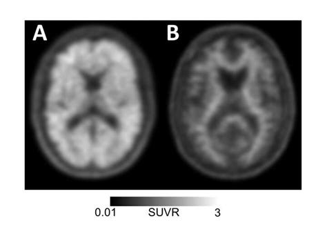 An Amyoid Pet Scan Can Detect Alzheimer's—But It's Not Covered By ...