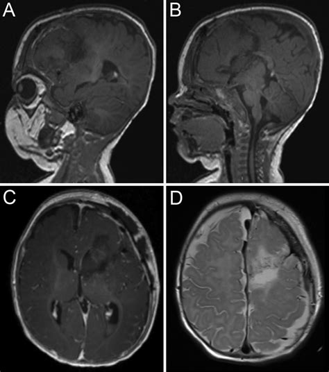 Unilateral prefrontal lobotomy for epilepsy: technique and surgical anatomy in: Neurosurgical ...