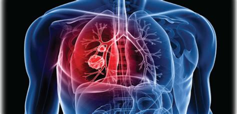 Targeted Therapies in Treatment of ALK-Positive NSCLC