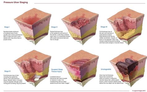 Pressure Ulcer Staging Chart Stages Of Pressure Injuries Pressure Ulcer Images