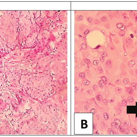 A): Low power view of the breast infiltrating ductal carcinoma; NOS ...