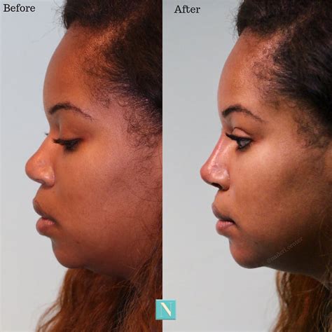 Liquid Nose Job Lift - Immediate Results No more nose bumps