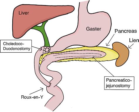 Pancreatic Cyst Icd 10 - Asking List