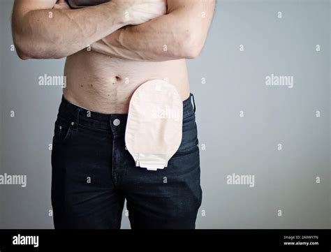 Colostomy bag hi-res stock photography and images - Alamy