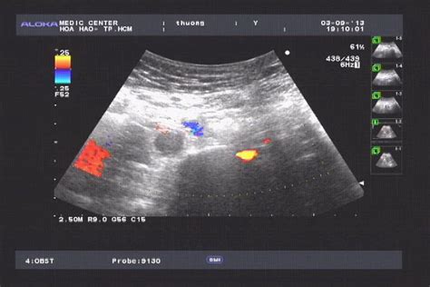 VIETNAMESE MEDIC ULTRASOUND: CASE 208: RETROPERITONEAL EXTRAUTERINE PREGNANCY, Dr PHAN THANH HẢI ...