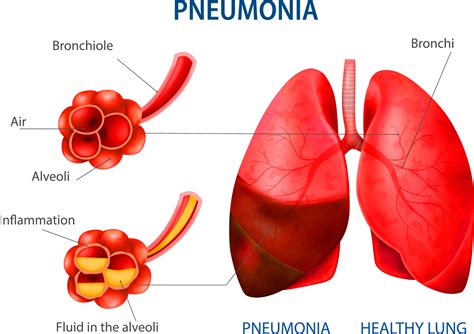 Human Lungs, Pneumonia, Lunges, Infographic, Clip Art, Illustration, Design, Infographics