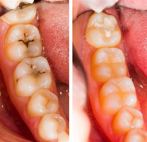 Tooth Colored Fillings - Cori S. Hvideberg, DMD