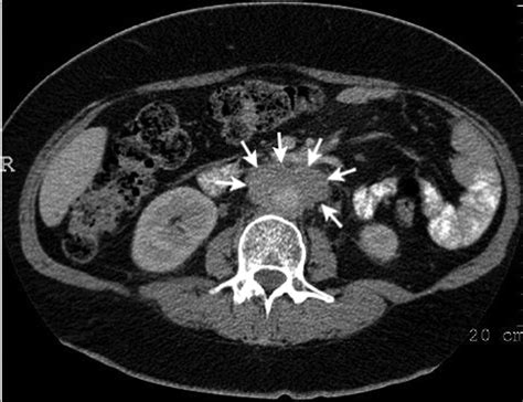 Retroperitoneal fibrosis | CMAJ