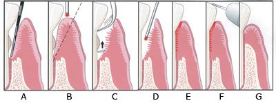 Laser Periodontal Therapy for Bone Regeneration - Dentistry Today