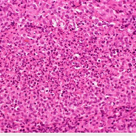 Neck lymph node biopsy: ematoxylin and eosin-stained sections prepared... | Download Scientific ...