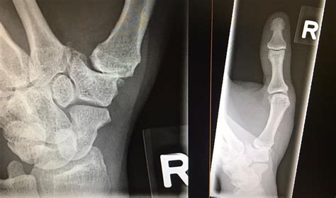 1st Carpometacarpal (CMC) Arthroplasty