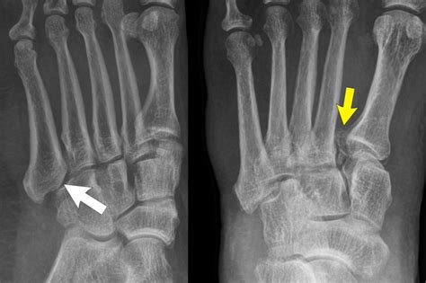 Cuneiform Bone Fracture