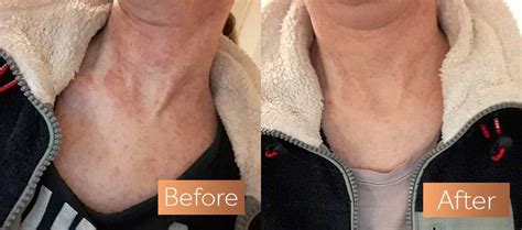 Absolute Collagen Before and After Pictures | Incredible Results