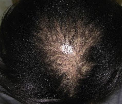 Central Centrifugal Cicatricial Alopecia - Dermatologic Clinics