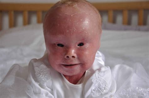 Harlequin ichthyosis causes, symptoms, diagnosis, survival & treatment