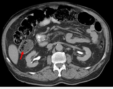 CT axial scan demonstrating cecal diverticulitis on the right (red ...