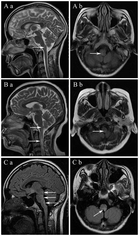 Brain Stem Tumor MRI