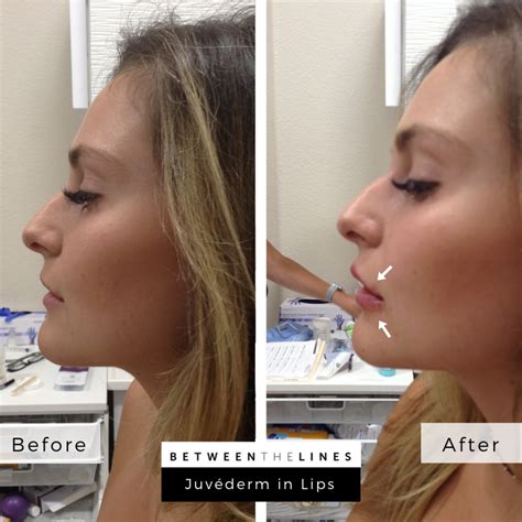 Before And After Juvederm Ultra Lips | Lipstutorial.org