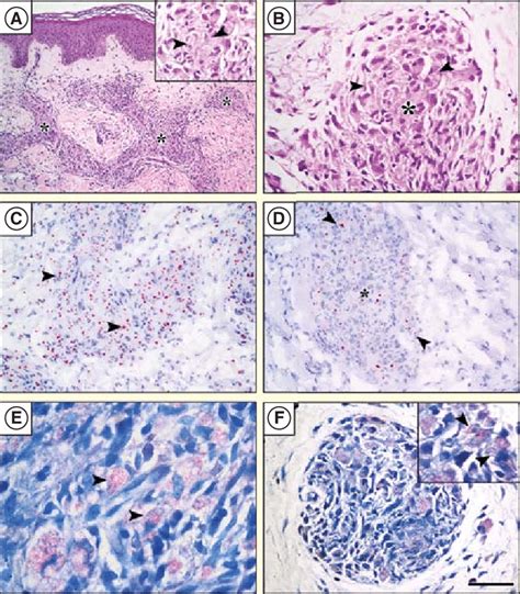 Histopathology of skin lesions of lepromatous patients with T1R ...