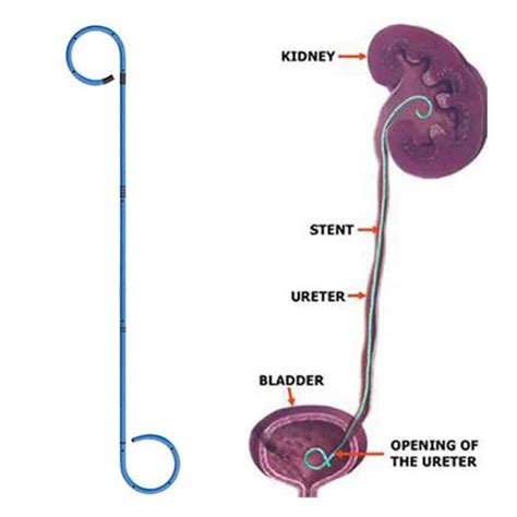 Ureteral Stent: Pros And Cons