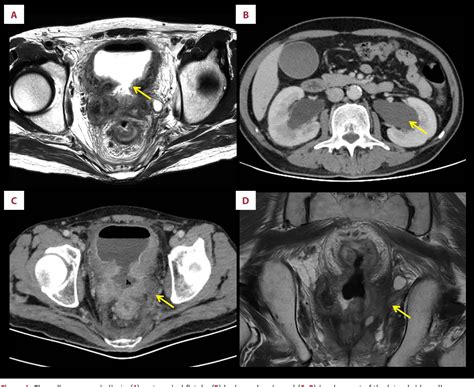 Figure 1 from Modular Pelvic Exenteration for Advanced Rectal Cancer in Frozen Pelvis | Semantic ...