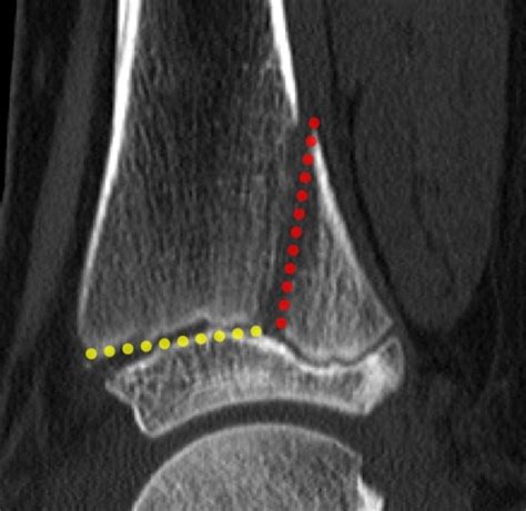 Salter-Harris Fractures | Radsource