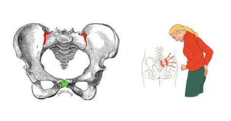 Sacroiliac Joint Pain Pregnancy