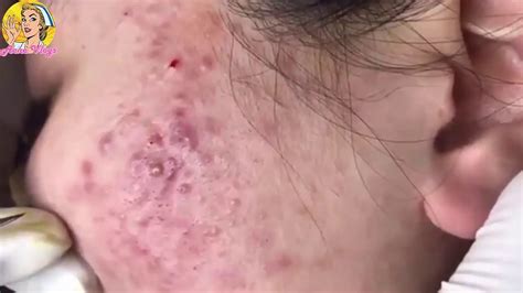 Giant Blackheads Extraction,#2 2018 - YouTube