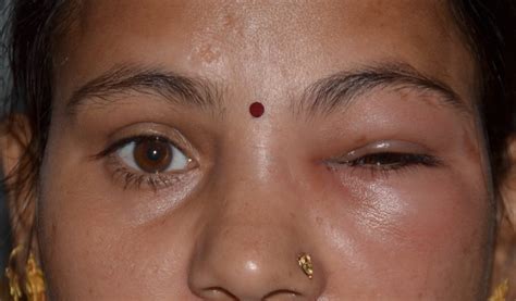 Dacryocystitis - Amritsar Eye Clinic