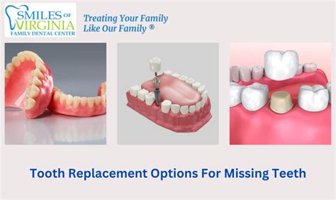 What Are The Best Tooth Replacement Options For Missing Teeth?