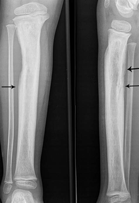 Osteomyelitis X Ray Features