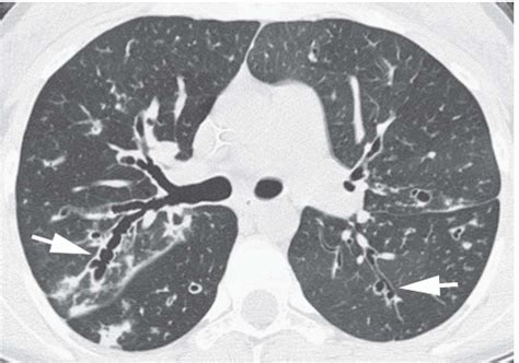 Bronchiectasis | Radiology Key