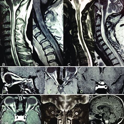 (A) Longitudinally extensive spinal cord lesions detected by MRI in... | Download Scientific Diagram