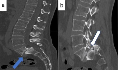 Med Educational Lumbar Spondylolisthesis Grade 1 And - vrogue.co