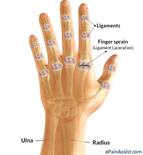 엄지 중수-수지 관절 탈구 및 인대 손상(1st MCP joint dislocation vand ligament injury) : 스키를 타다가 엄지가 꺾였어요 : 네이버 블로그