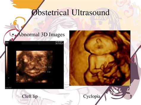 Obstetrical Ultrasound