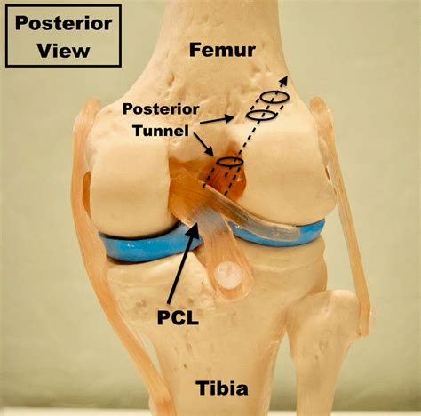 Essentials of Choosing an ACL Graft