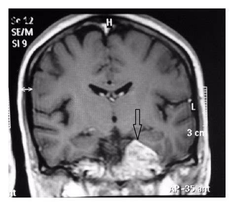 MRI precontrast showing altered signal intensity of the clivus, coronal... | Download Scientific ...